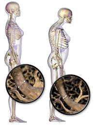7 Steps To Prevent And Manage Osteoporosis